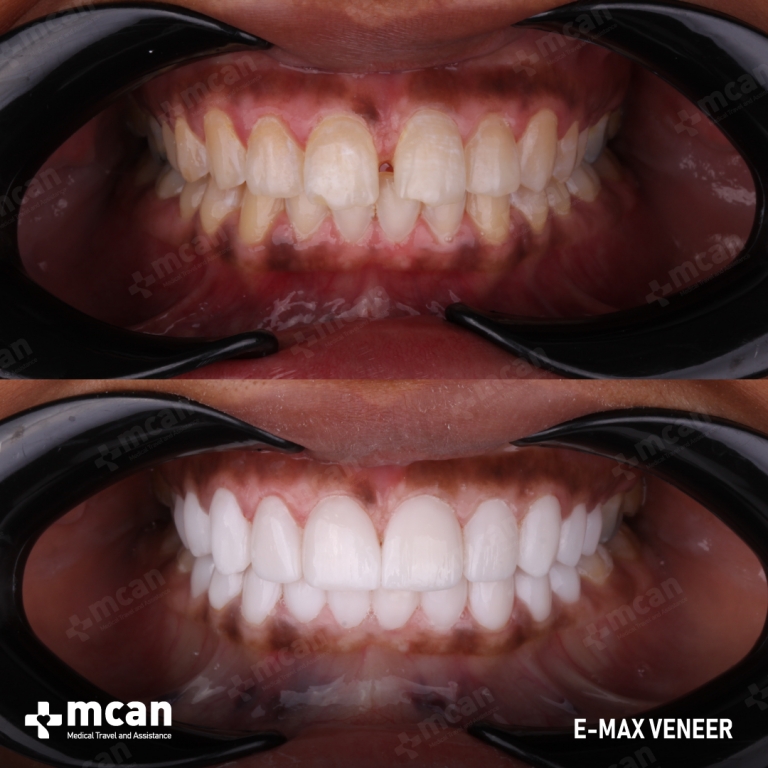 E-MAX VENEER Before and After