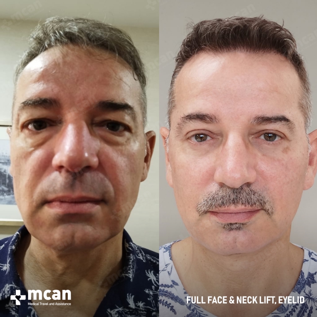 mcan health facelift before and after
