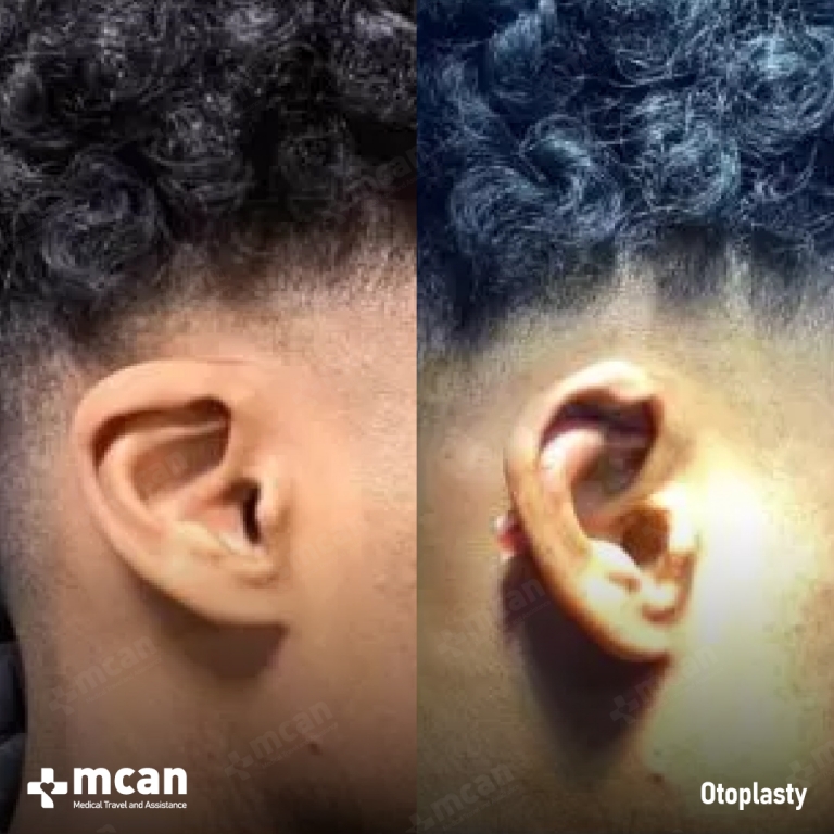 Ear Reshaping Before & Afters 1