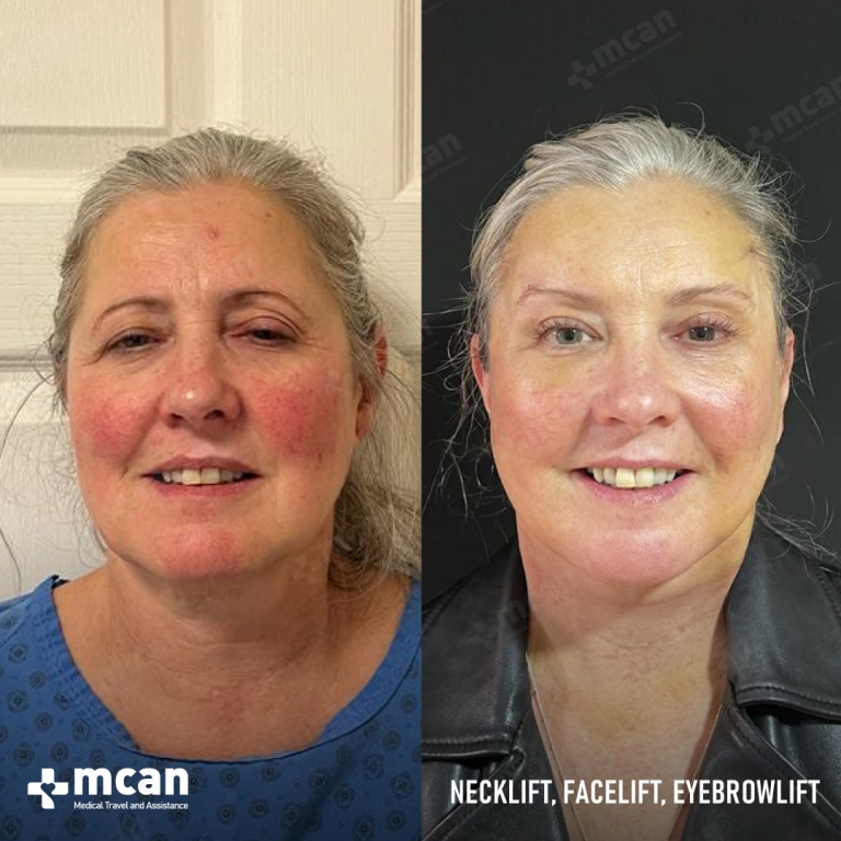 Facelift Before & Afters  1