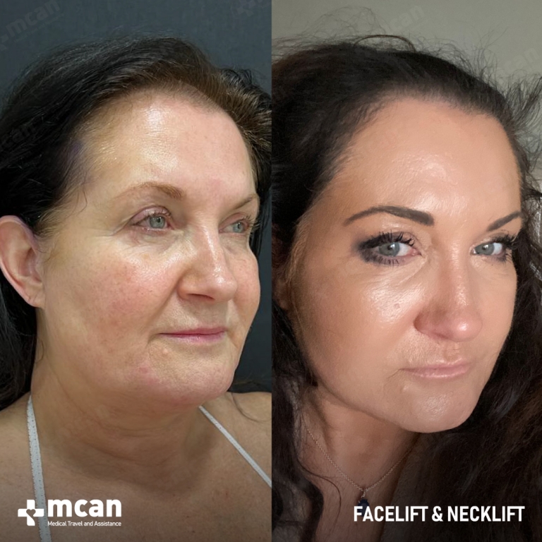 Facelift Before & Afters  2