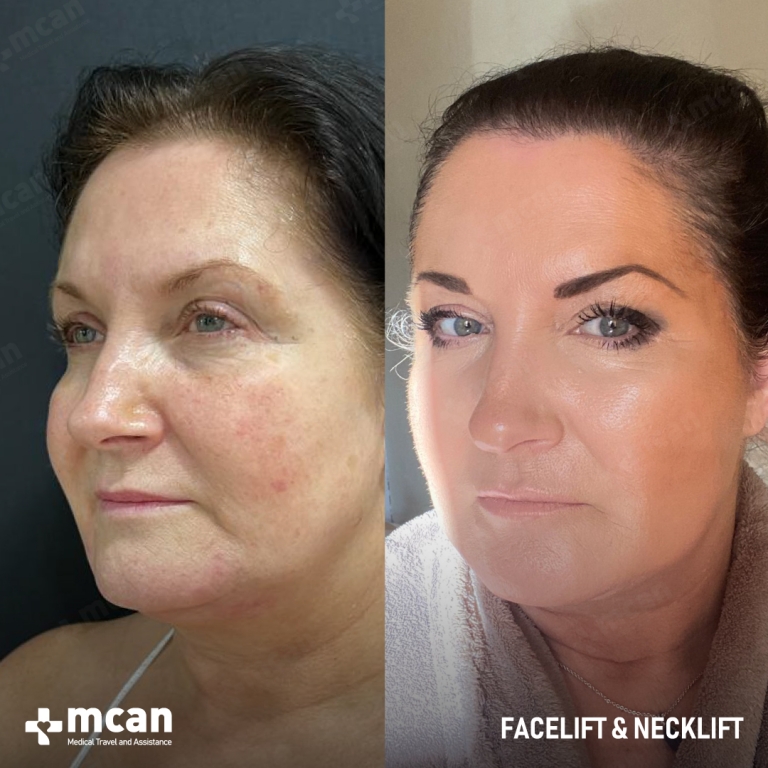 Facelift Before & Afters  3