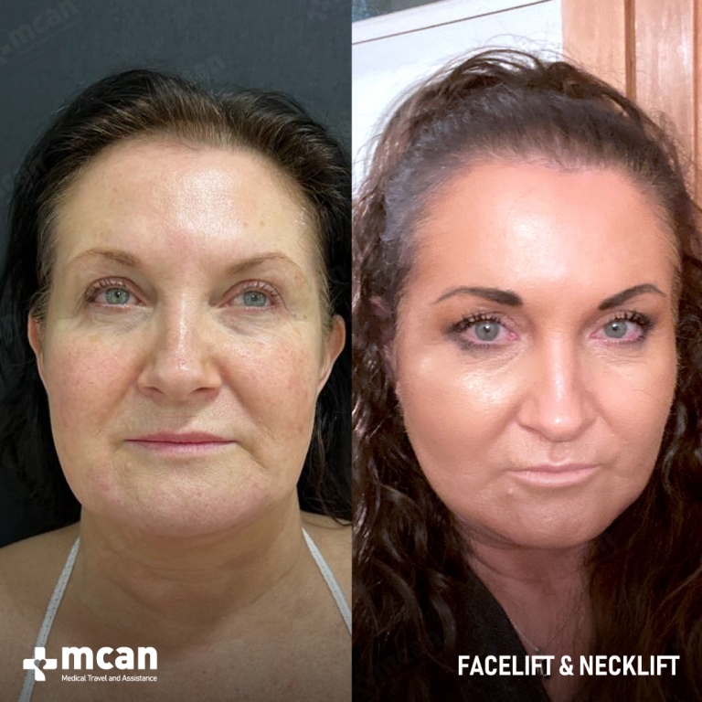 Facelift Before & Afters  1