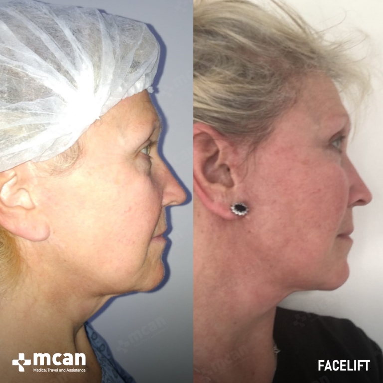 Facelift Before & Afters 1