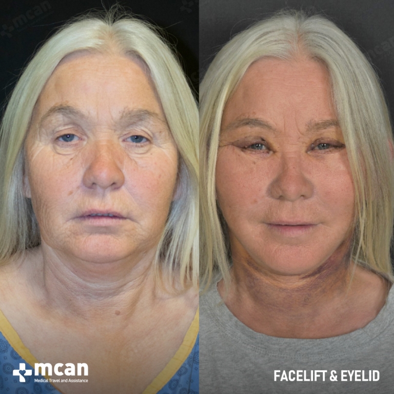 Facelift Before & Afters 1