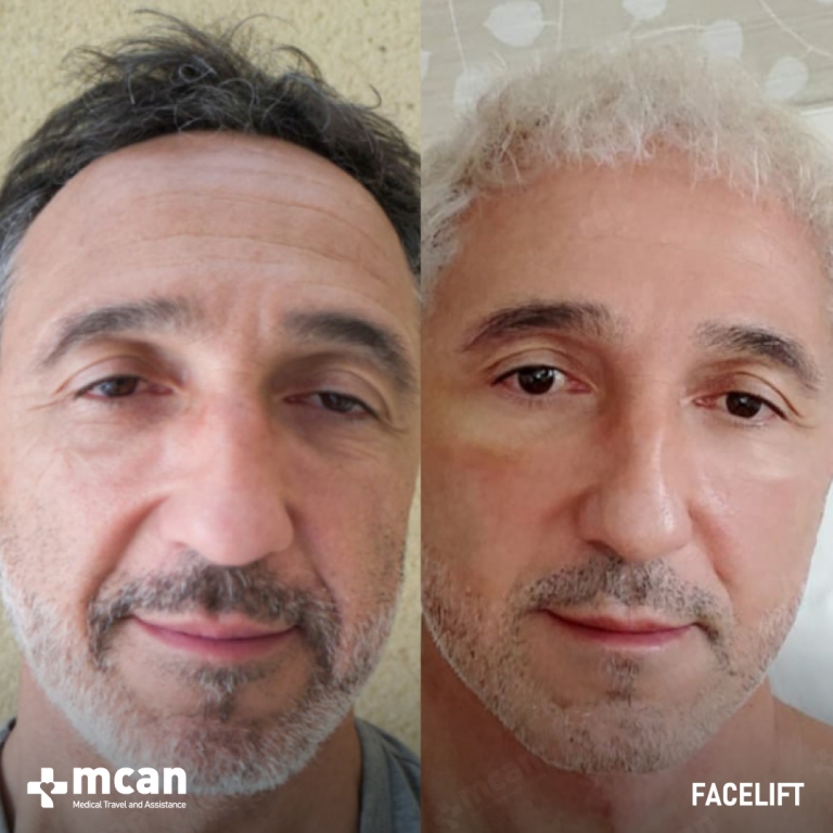 Facelift Before & Afters 1