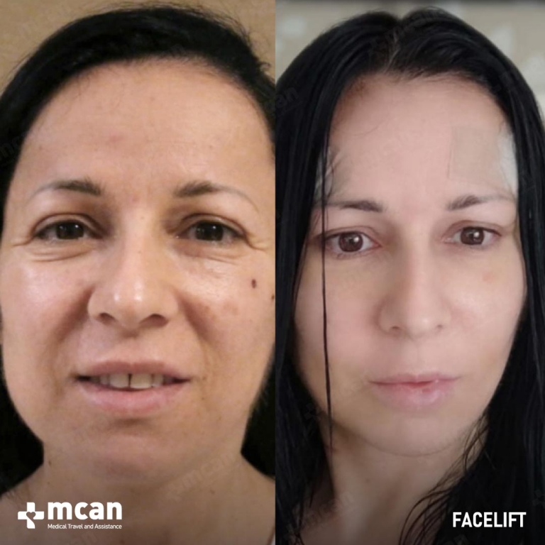 Facelift Before & Afters 1