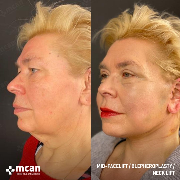 Facelift Before & Afters  3