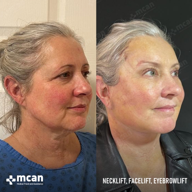 Facelift Before & Afters  2