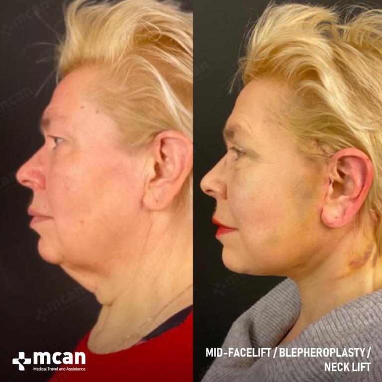 Facelift Before & Afters  2