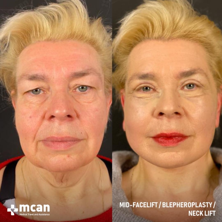 Facelift Before & Afters  1