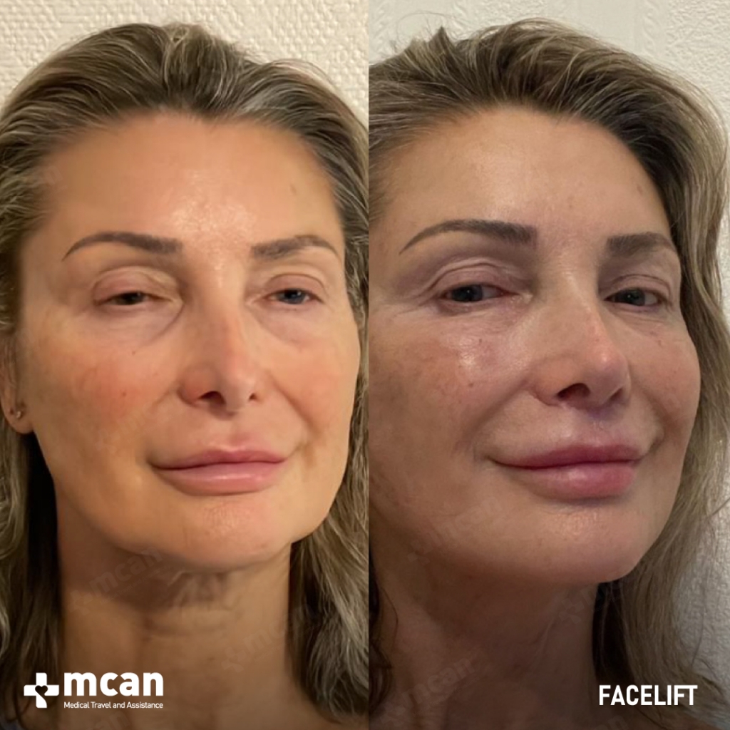 Facelift Before After 22