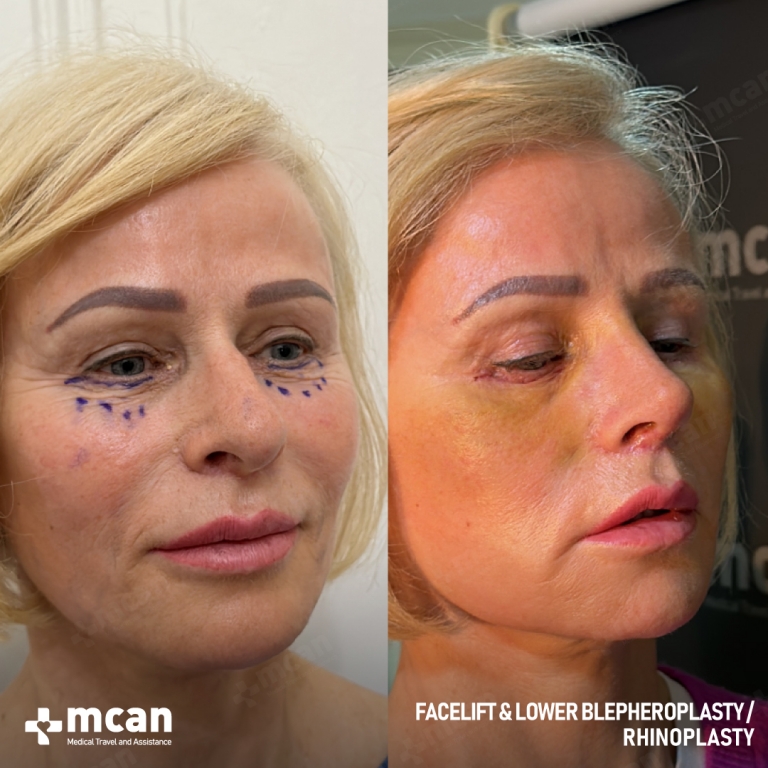 Facelift Before & Afters  1