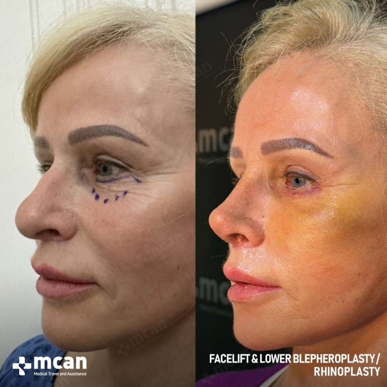 Facelift Before & Afters  2