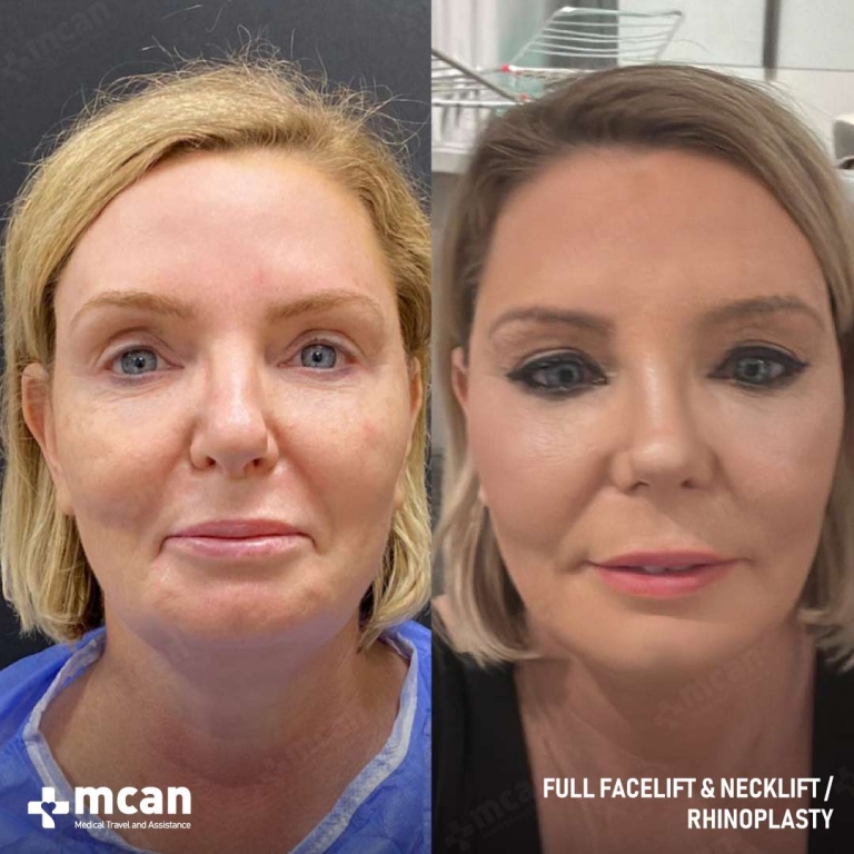 Facelift Before & Afters 1