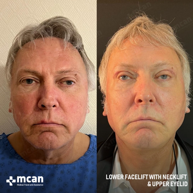 Facelift Before & Afters 1