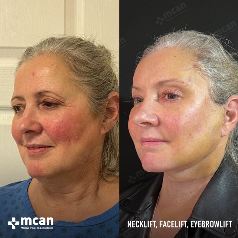 Facelift Before & Afters  3