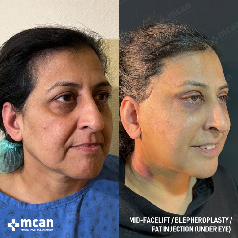 Facelift Before & Afters  2