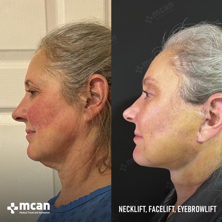 Facelift Before & Afters  4