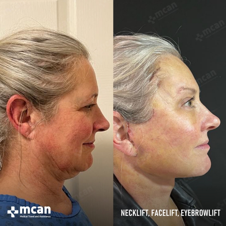 Facelift Before & Afters  5