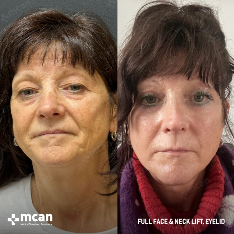 Facelift Before & Afters 1