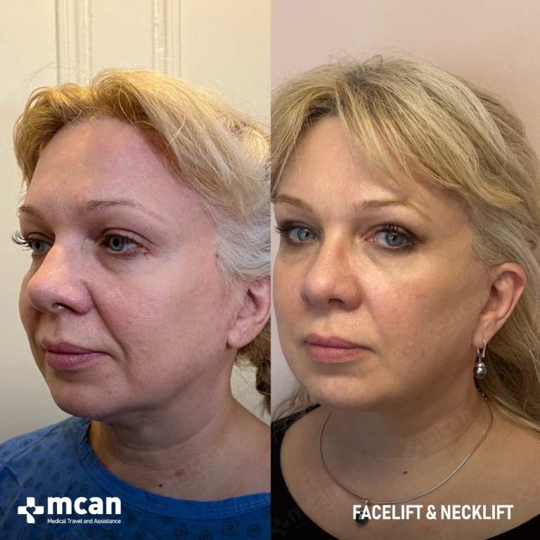 Facelift Before & Afters 1