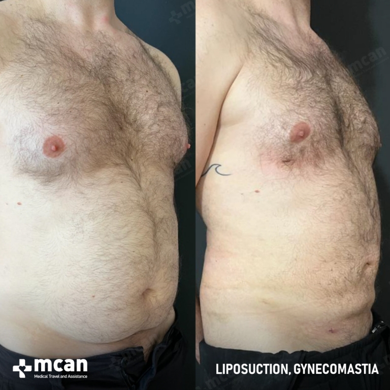 Gynecomastia Liposuction Before & Afters 1