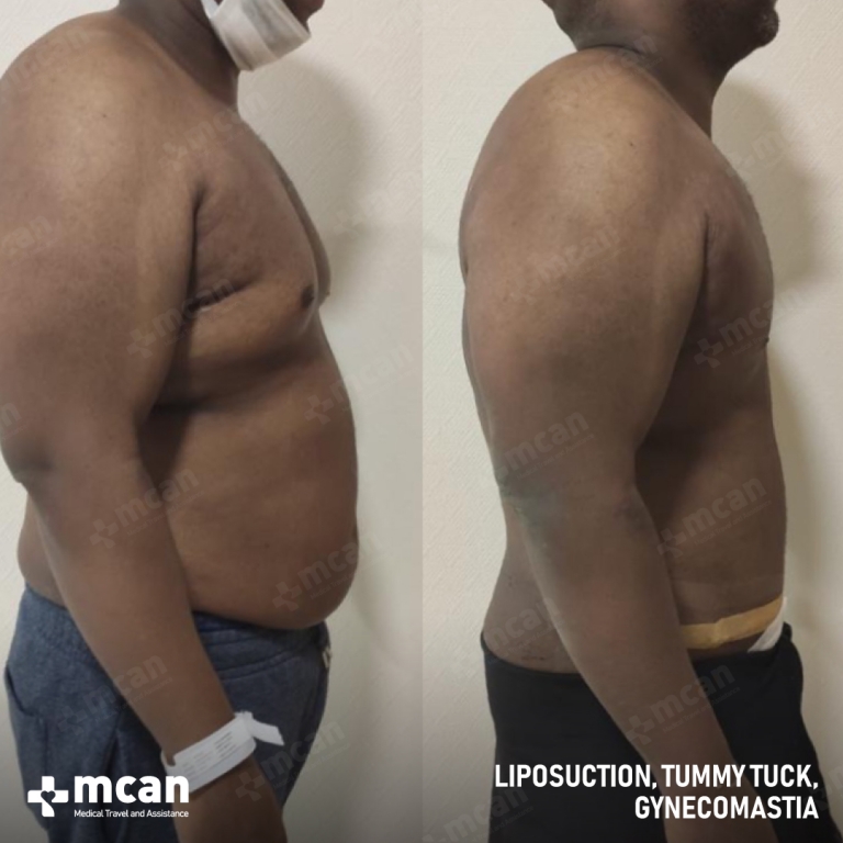 Gynecomastia Liposuction Before & Afters  1