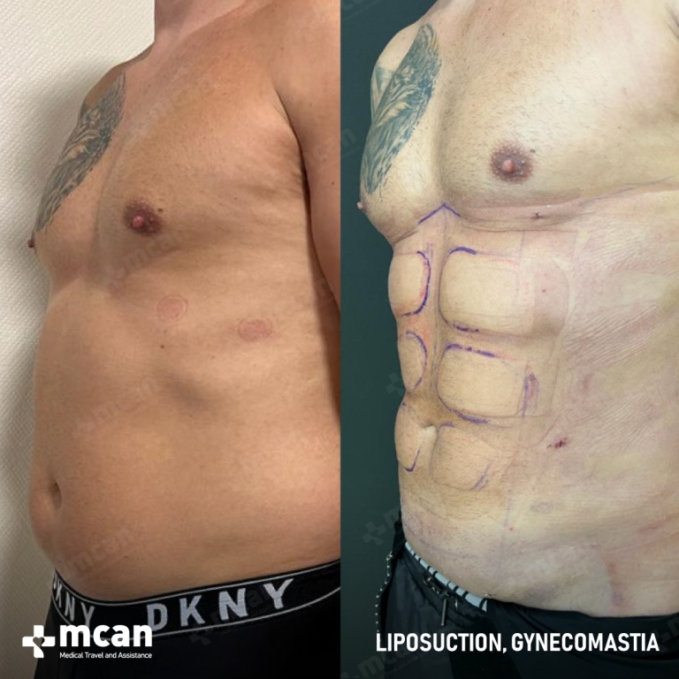 Gynecomastia Liposuction Before & Afters  2