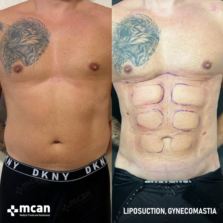 Gynecomastia Liposuction Before & Afters  1