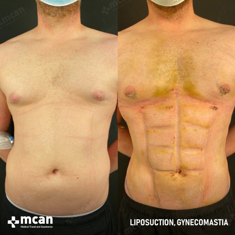 Gynecomastia Liposuction Before & Afters 1