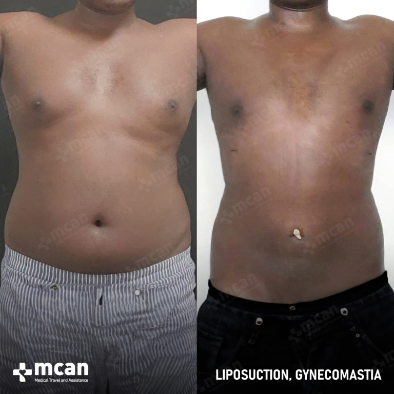 Gynecomastia Liposuction Before & Afters 1