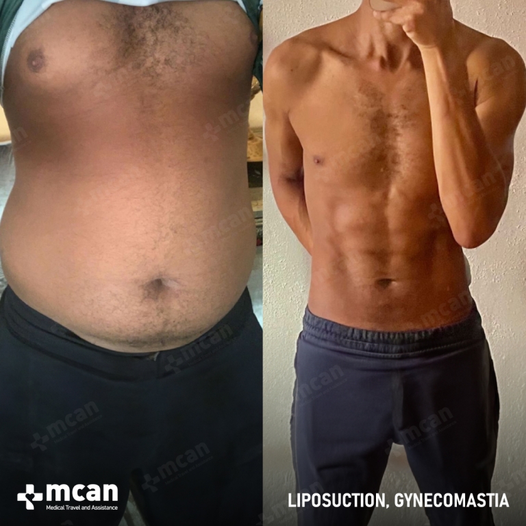 Gynecomastia Liposuction Before & Afters 1