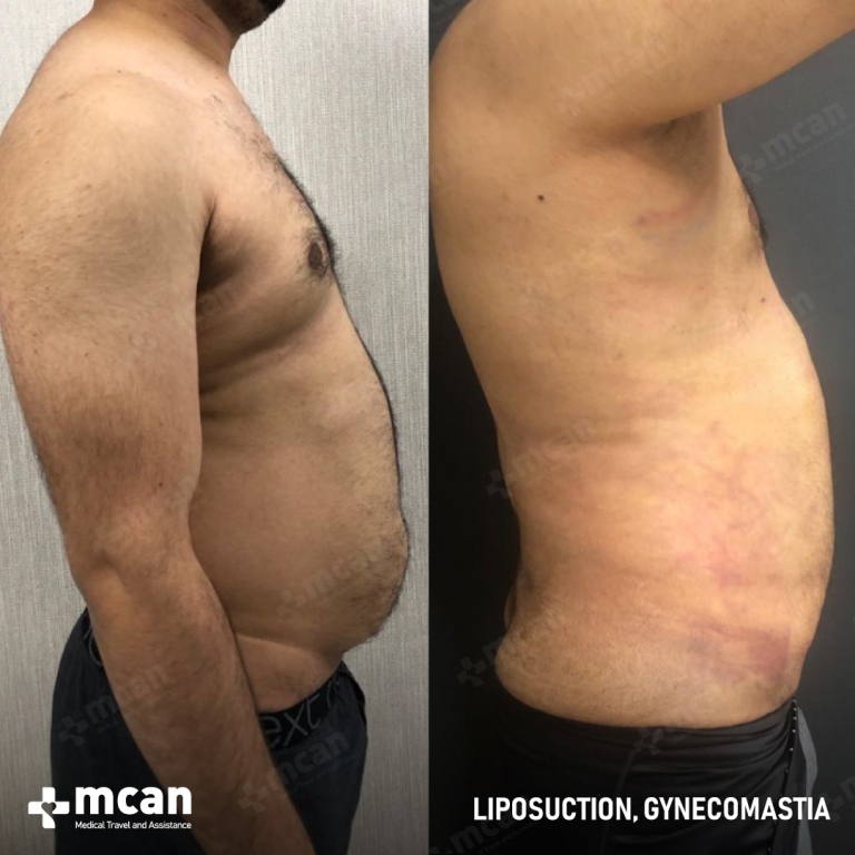 Gynecomastia Liposuction Before & Afters 1