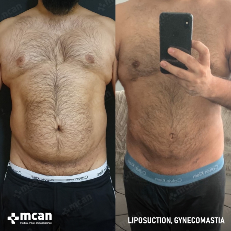 Gynecomastia Liposuction Before & Afters 1