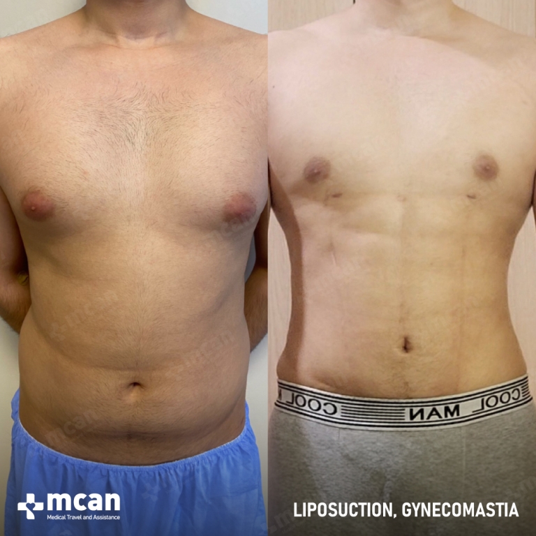 Gynecomastia Liposuction Before & Afters 1