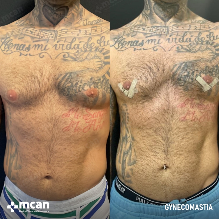 Gynecomastia Liposuction Before & Afters 1