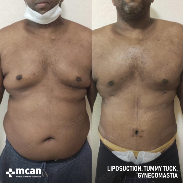 Gynecomastia Liposuction Before & Afters  3