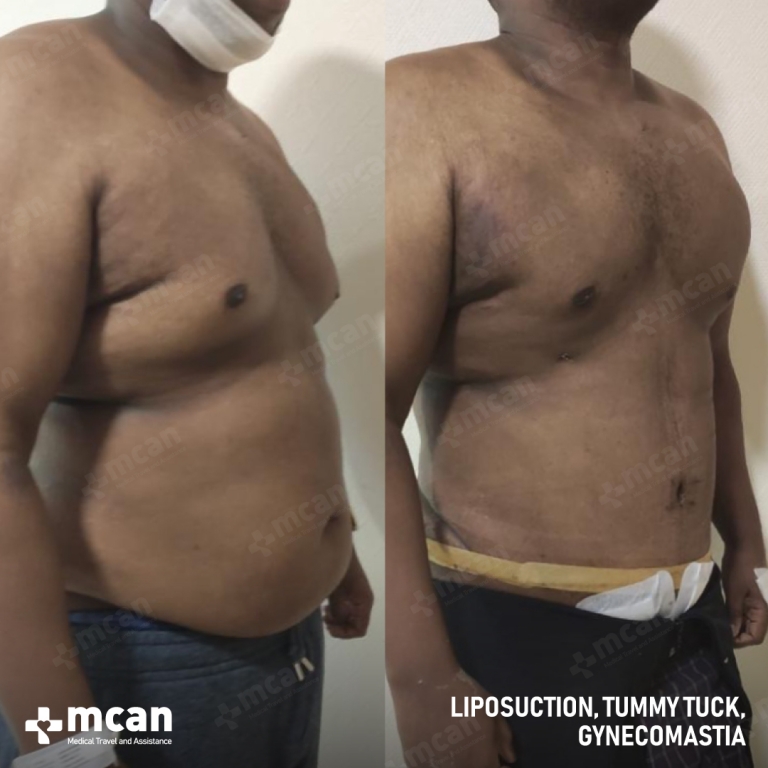 Gynecomastia Liposuction Before & Afters  2