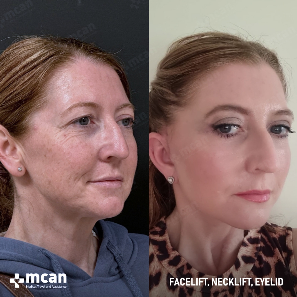 lifting facial antes y despues con mcan health 2