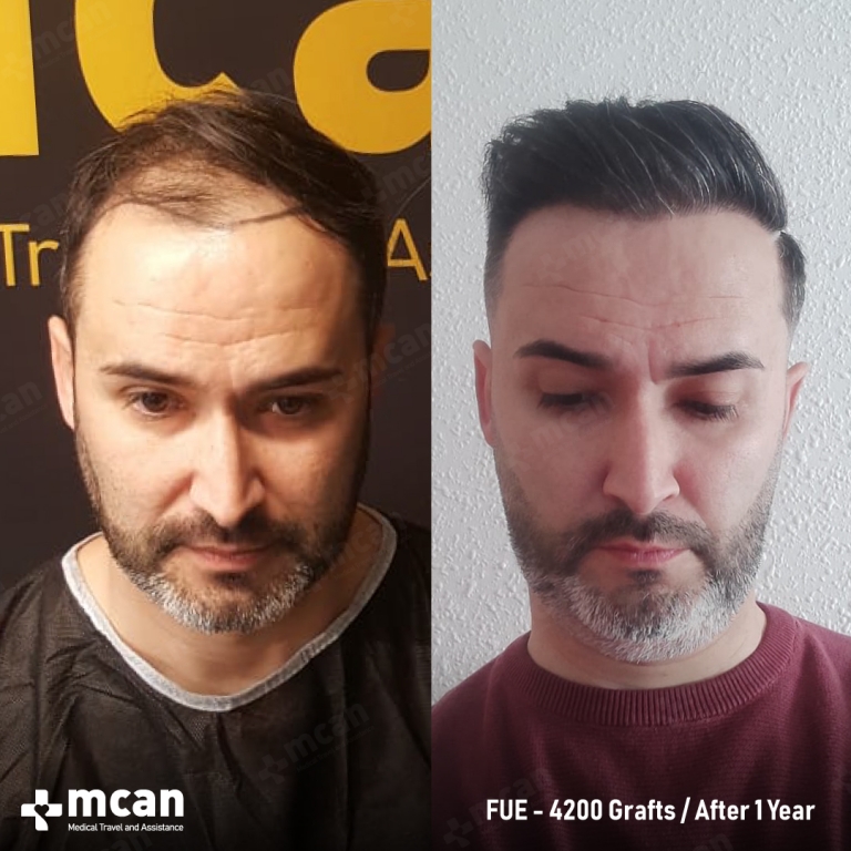 Juan M. Before and After