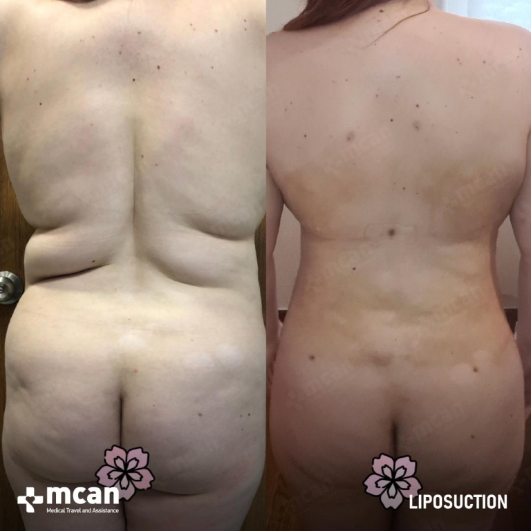 Liposuction Before & Afters 1