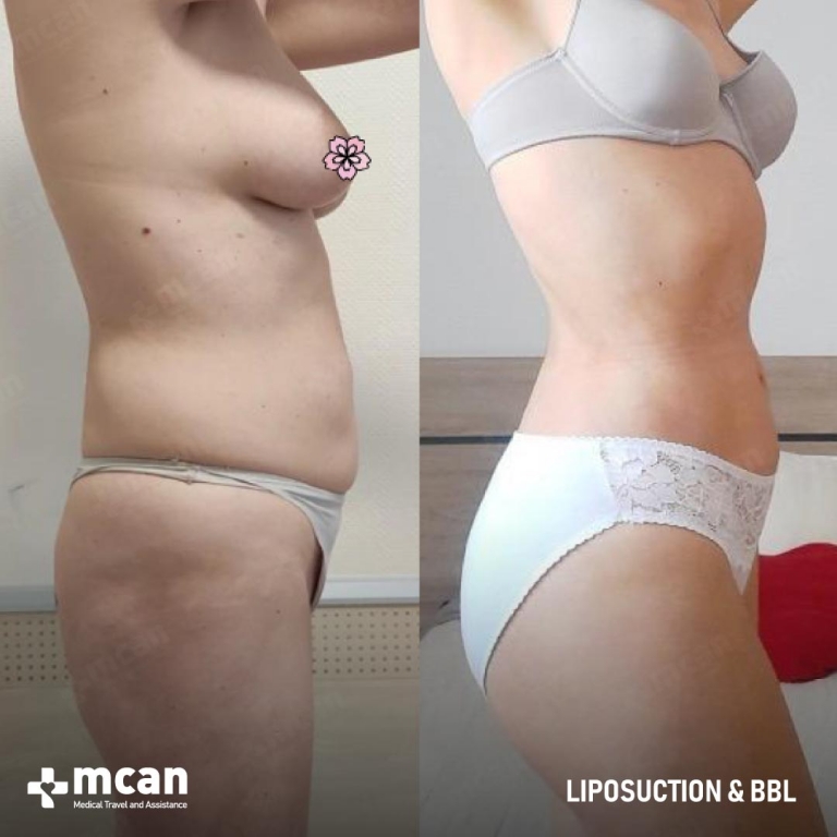 Liposuction Before & Afters 1