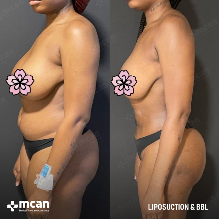 Liposuction Before & Afters 1