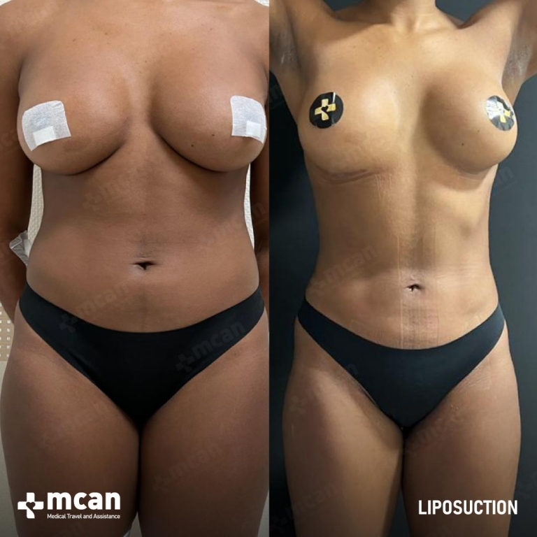 Liposuction Before & Afters 1