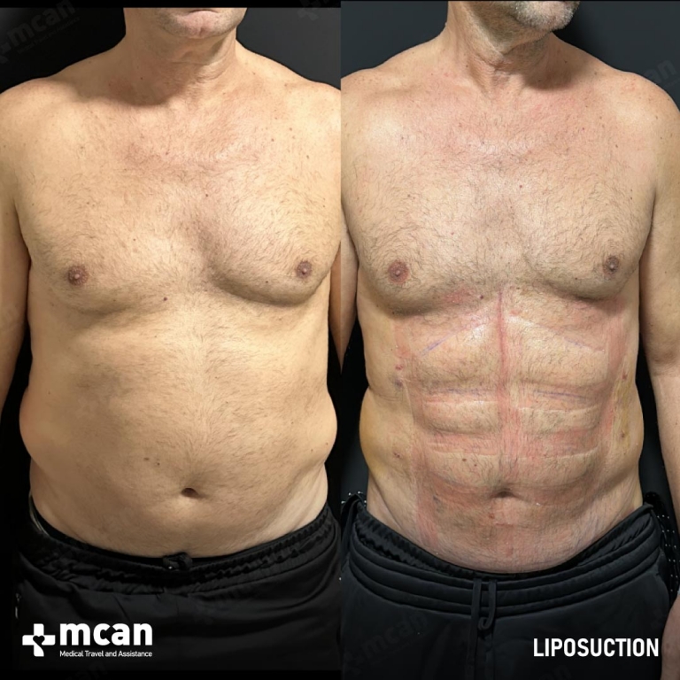 Liposuction Before & Afters 1