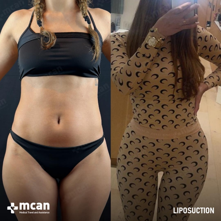 Liposuction Before & Afters 1