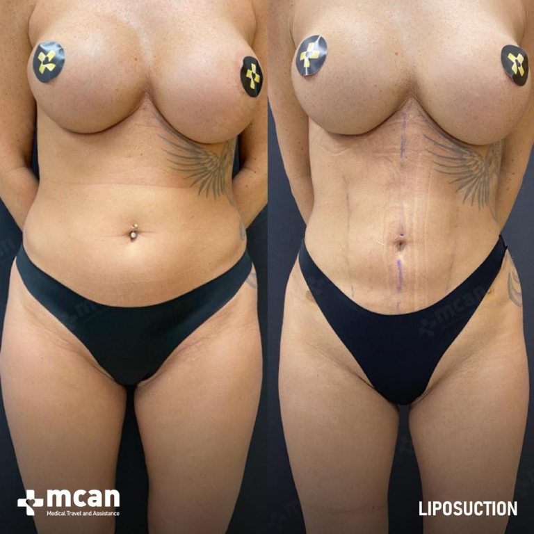 Liposuction Before & Afters  1