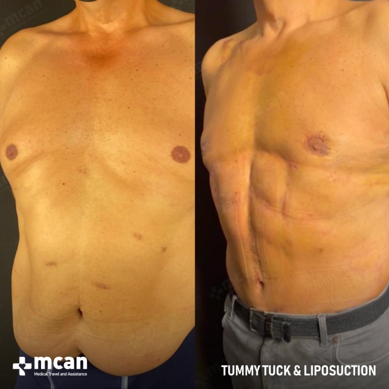 Liposuction Before & Afters 1