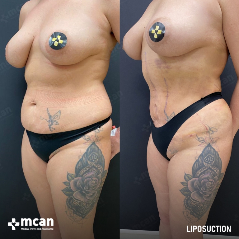 Liposuction Before & Afters  3